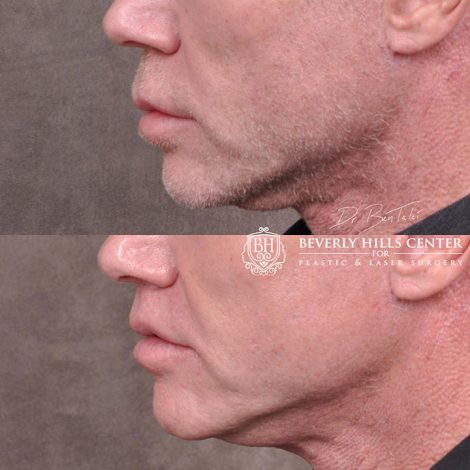 Modified upper lip lift FOR MEN - Left Side