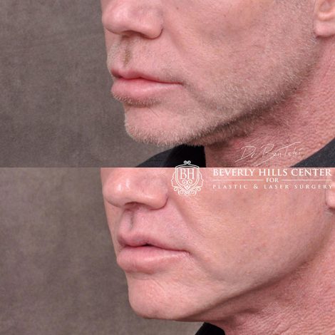 Modified upper lip lift FOR MEN - Left Side