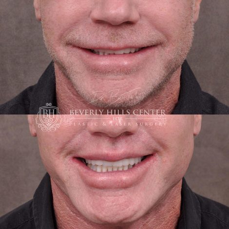 Modified upper lip lift FOR MEN - Front