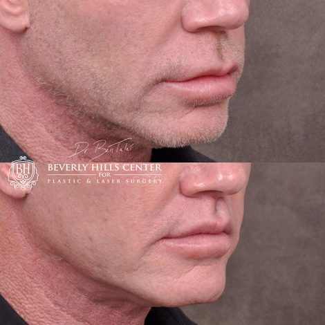 Modified upper lip lift FOR MEN - Right Side