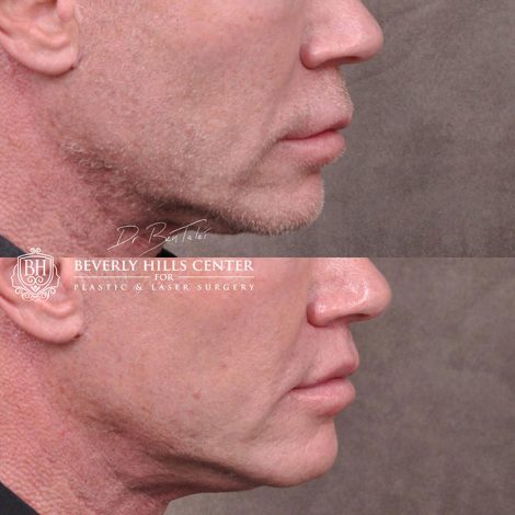 Modified upper lip lift FOR MEN - Right Side