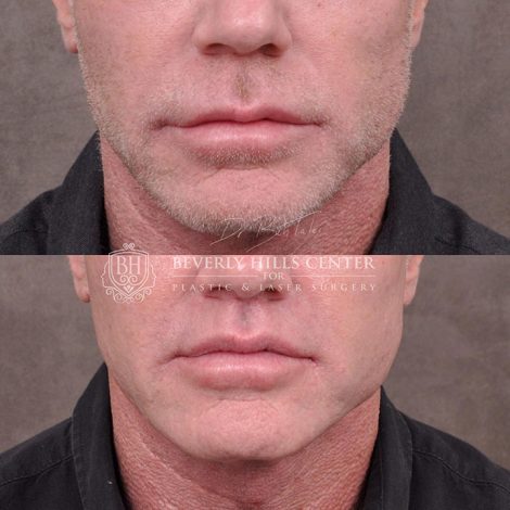 Modified upper lip lift FOR MEN - Front