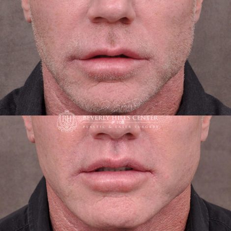 Modified upper lip lift FOR MEN - Front