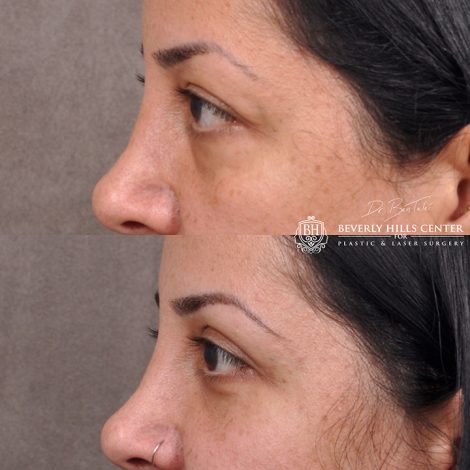 Upper & lower Blepharoplasty