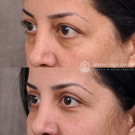 Upper & lower Blepharoplasty