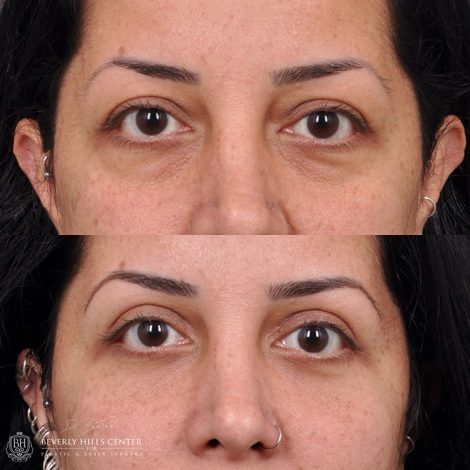 Upper & lower Blepharoplasty