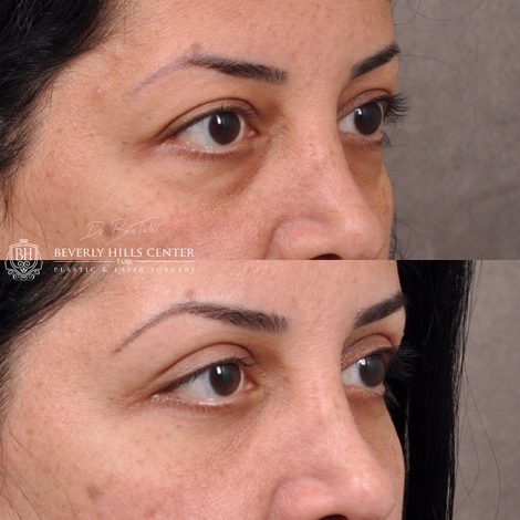 Upper & lower Blepharoplasty
