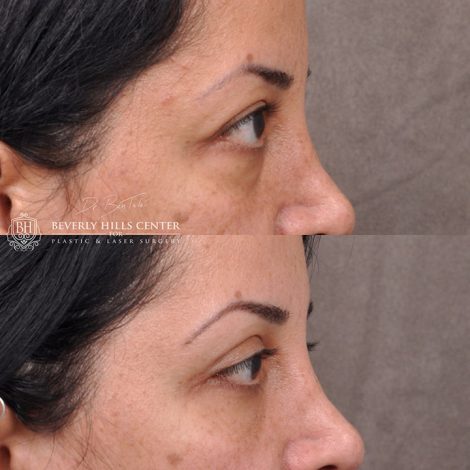 Upper & lower Blepharoplasty