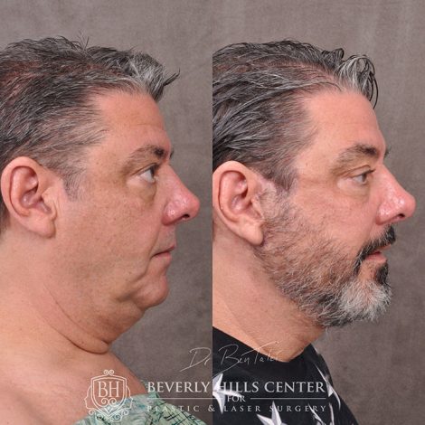 Auralyft for Men with lower eyelid rejuvenation - Right Side