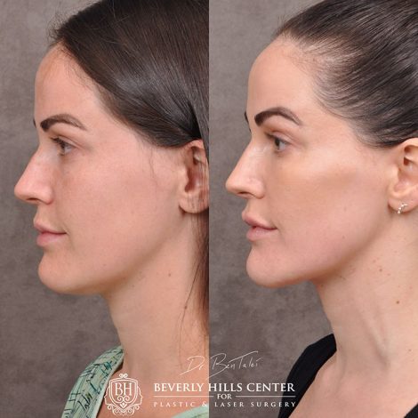 Weekend Necklift - Right Side