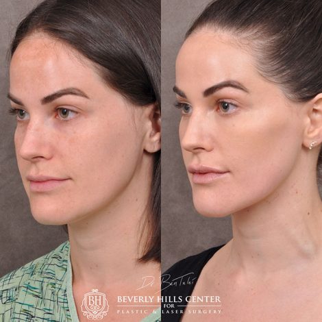 Weekend Necklift - Right Side