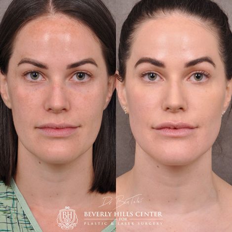 Weekend Necklift - Front