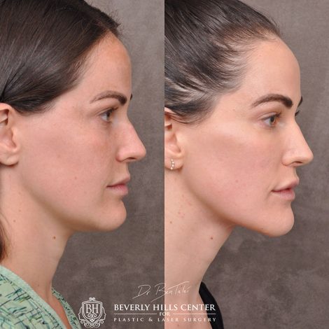 Weekend Necklift - Left Side