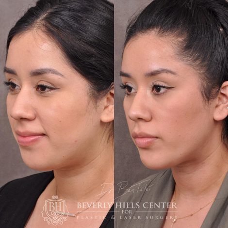 Weekend Necklift - Left Side