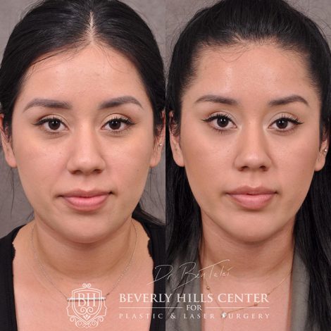 Weekend Necklift - Front