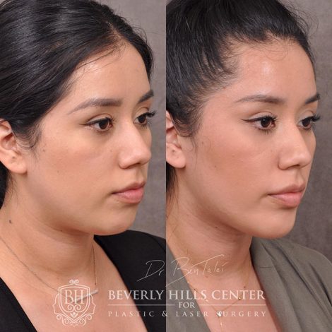 Weekend Necklift - Right Side