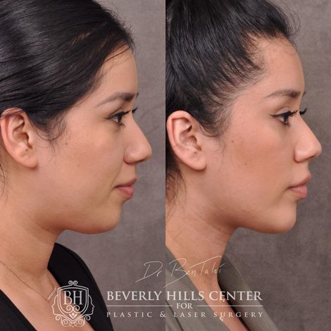 Weekend Necklift - Right Side