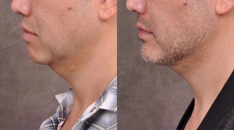 Weekend Necklift - Left Side