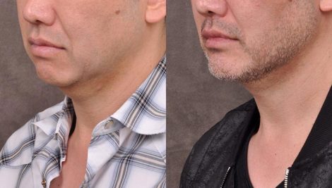 Weekend Necklift - Left Side