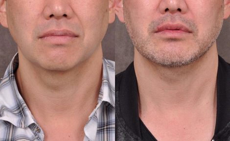 Weekend Necklift - Front