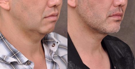 Weekend Necklift - Right Side