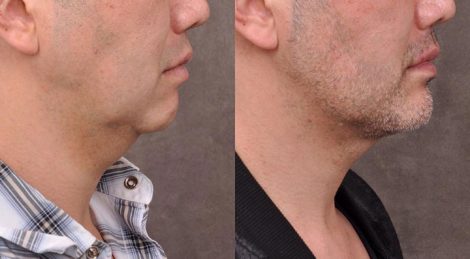 Weekend Necklift - Right Side