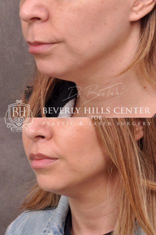 Modified Upper Lip Lift with corner release - Left Side