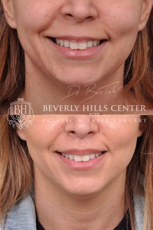 Modified Upper Lip Lift with corner release - Front