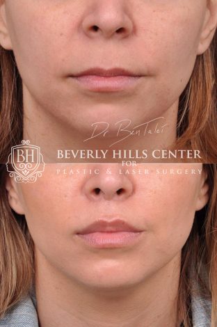 Modified Upper Lip Lift with corner release - Front