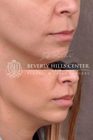 Modified Upper Lip Lift with corner release - Right Side