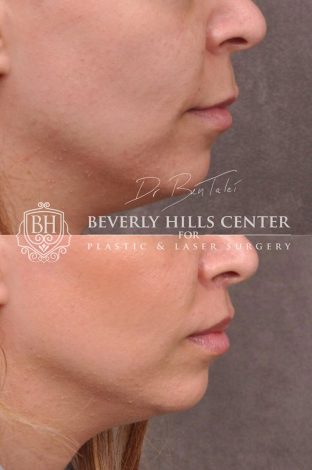 Modified Upper Lip Lift with corner release - Right Side