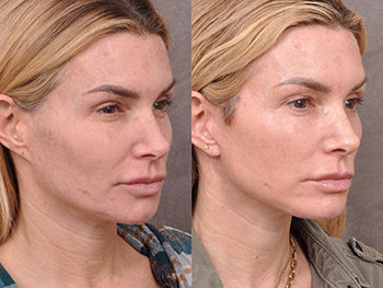 Beverly Hills Center Female Patient Before and After Auralyft Procedure