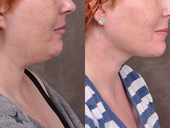 Beverly Hills Center Female Patient Before and After Mini Weekend Necklift Procedure