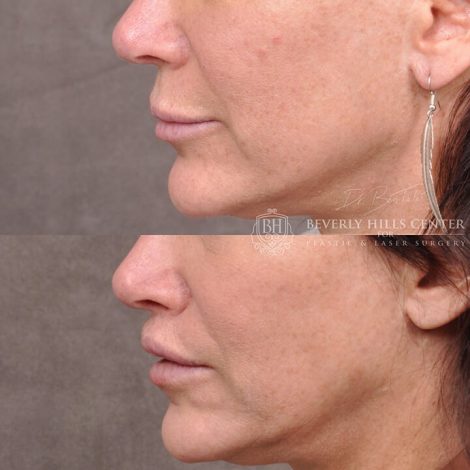 Deep Plane modified upper lip lift - Right Side