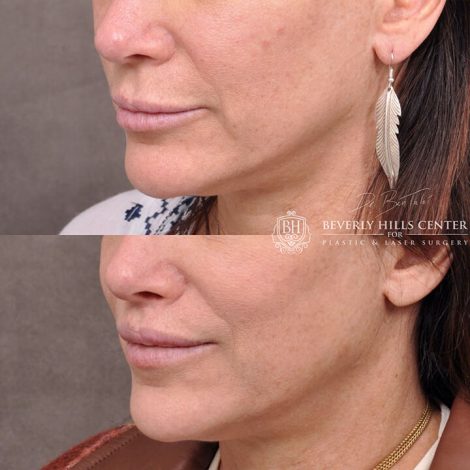 Deep Plane modified upper lip lift - Right Side