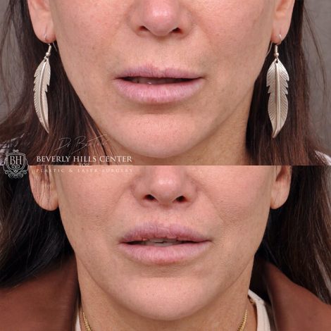 Deep Plane modified upper lip lift - Front