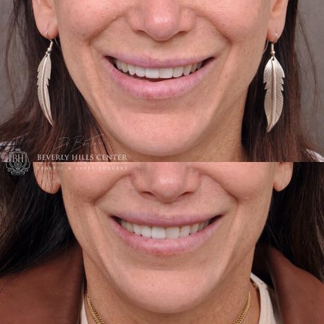 Deep Plane modified upper lip lift - Front