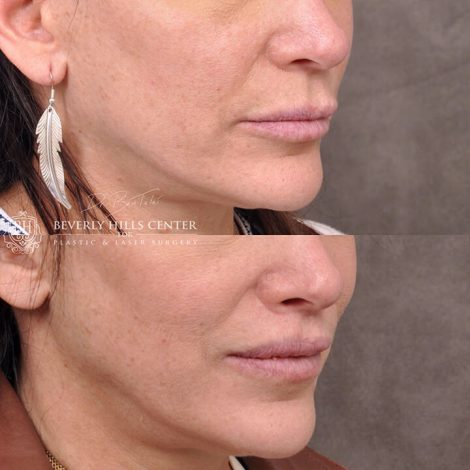 Deep Plane modified upper lip lift - Left Side