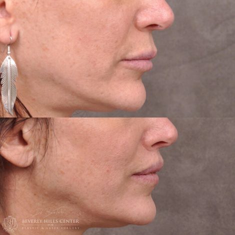 Deep Plane modified upper lip lift - Left Side