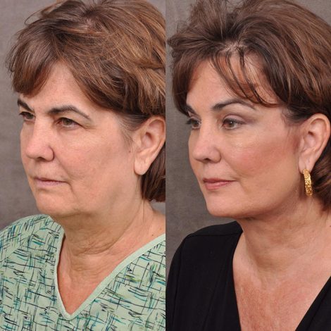 AuraLyft, Browlift & Blepharoplasty