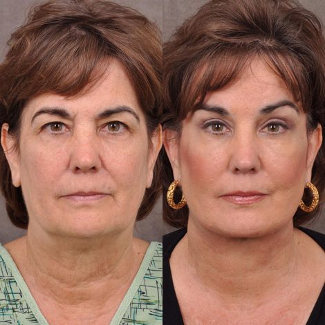 AuraLyft, Browlift & Blepharoplasty