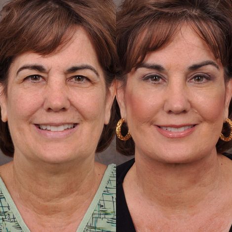 AuraLyft, Browlift & Blepharoplasty