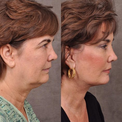 AuraLyft, Browlift & Blepharoplasty