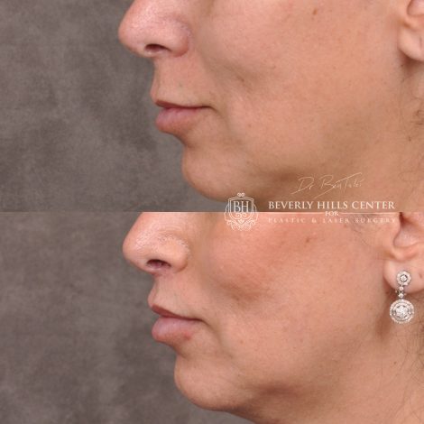 Lip Lift with 2m - Left Side
