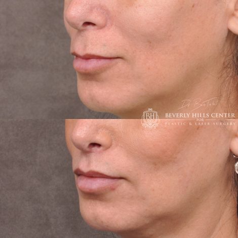 Lip Lift with 2m - Left Side
