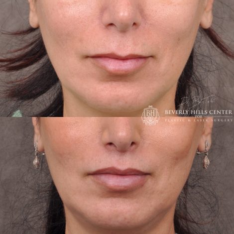 Lip Lift with 2m - Front