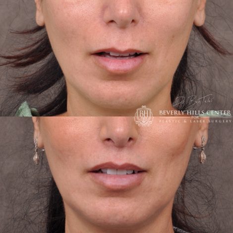 Lip Lift with 2m - Front