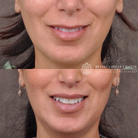 Lip Lift with 2m - Front