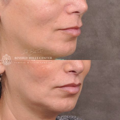 Lip Lift with 2m - Right Side
