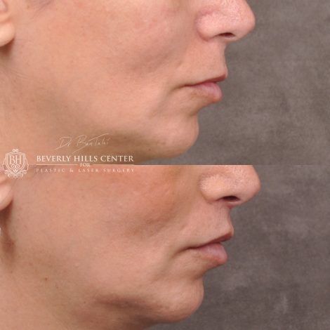Lip Lift with 2m - Right Side